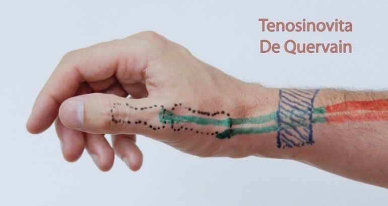 De Quervain’s Tenosynovitis