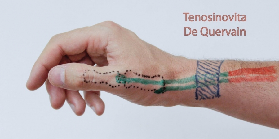 De Quervain’s Tenosynovitis