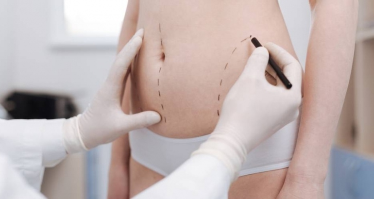 Liposuction